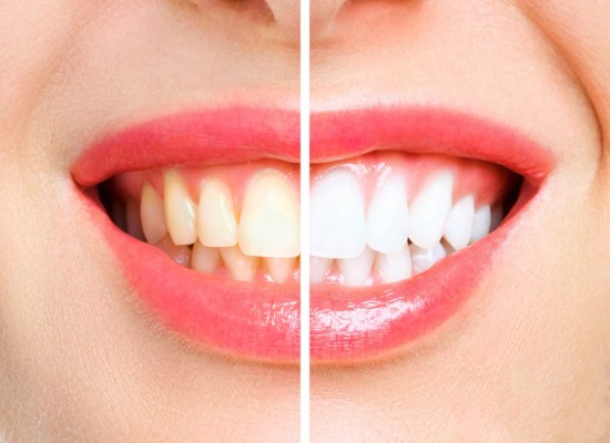 Jak skutecznie wybielać zęby?