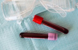 Płytki krwi powyżej normy – o czym świadczą?
