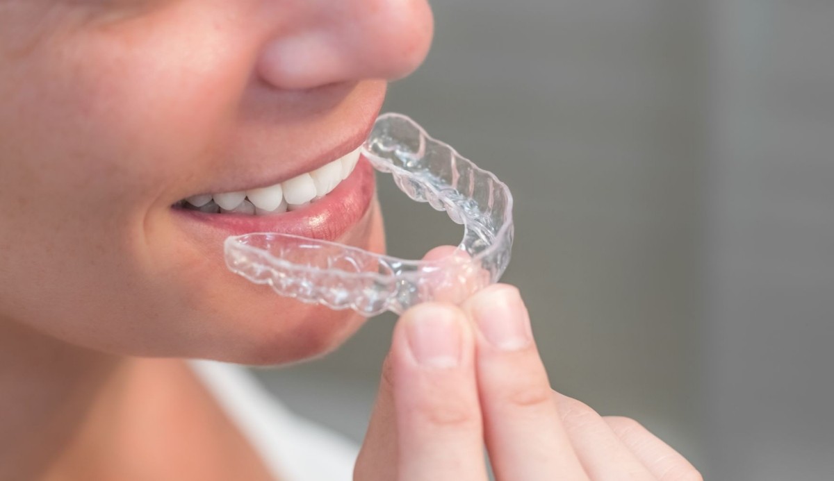 Aparaty Invisalign - Hit czy Kit