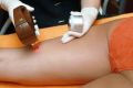 Czy depilacja laserowa boli? Fakty, odczucia i sposoby łagodzenia dyskomfortu