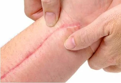 <b>Jak pielęgnować świeże blizny?</b>